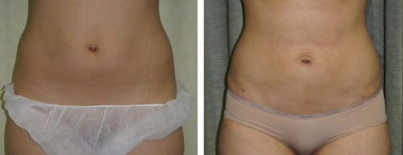 Lipo Before and After