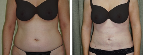 Laser Liposuction Before and after