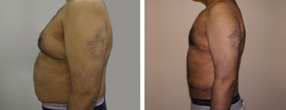 Smart Lipo Before and after