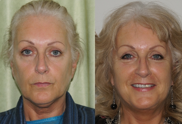 One Stitch Facelift  Micro Facelift London, UK Price & Cost