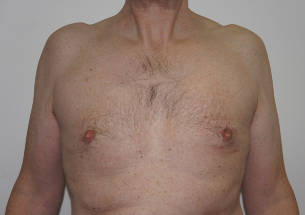 Breast Fat Transfer Before and After Image