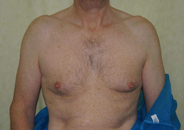 Breast Fat Transfer Before and After Picture