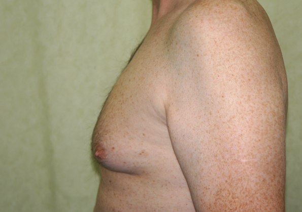 Breast Fat Transfer Before and After Picture