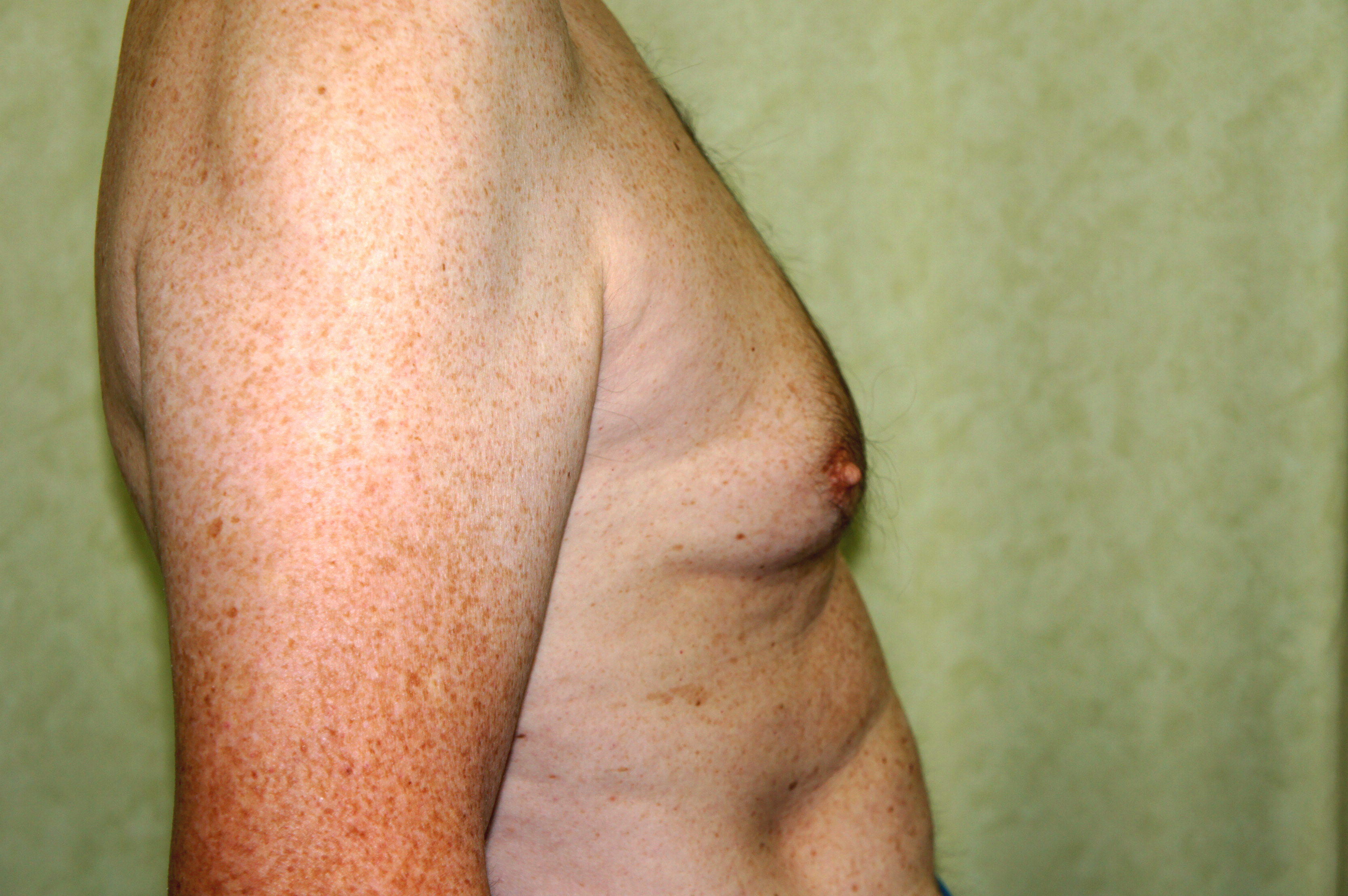 Breast Fat Transfer Before and After Picture