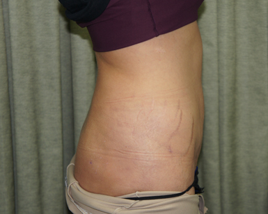 Liposuction Before and After Picture