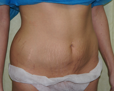 Liposuction Before and After Image