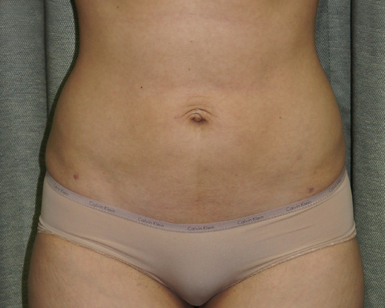 Smart Lipo Before and After Picture