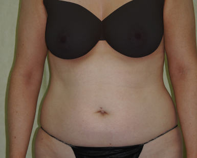 Vaser Liposuction Before and After Image