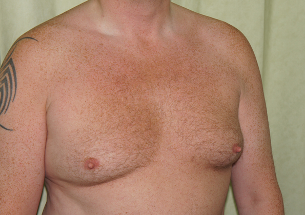 Breast Fat Transfer Before and After Picture