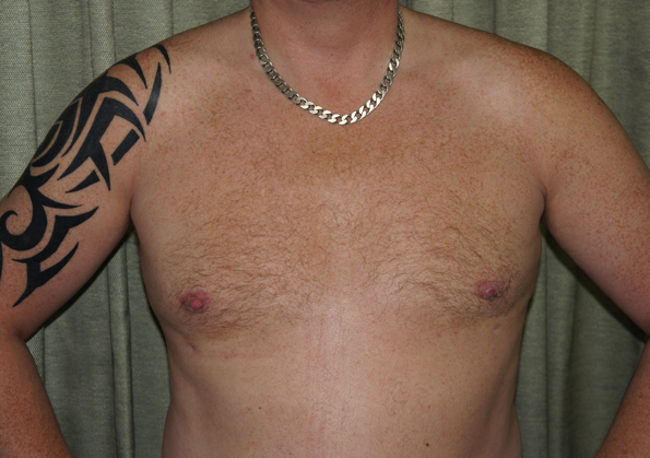 Breast Fat Transfer Before and After Image