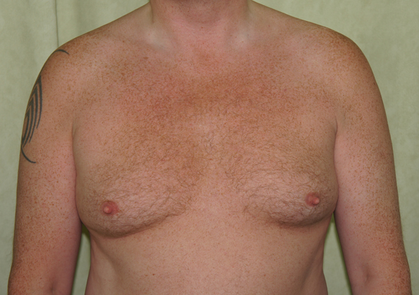 Breast Fat Transfer Before and After Picture