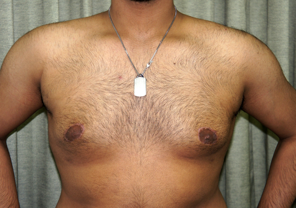 Breast Fat Transfer Before and After Image