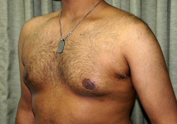 Breast Fat Transfer Before and After Image