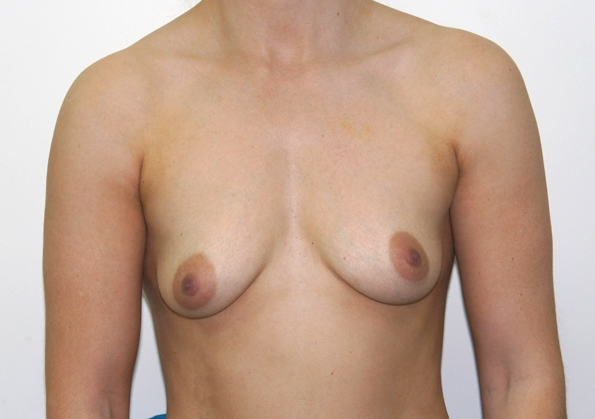 Breast Fat Transfer Before and After Picture