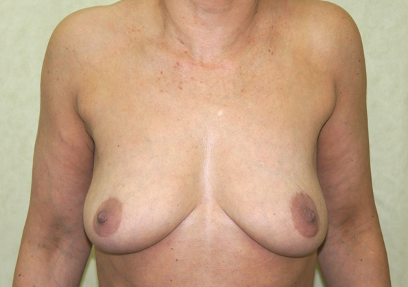 Breast Fat Transfer Before and After Picture