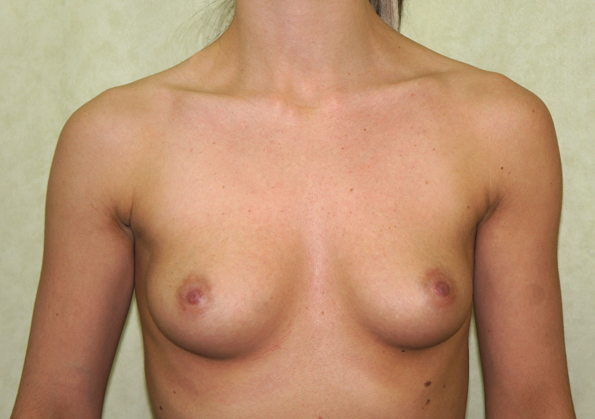 Breast Fat Transfer Before and After Picture