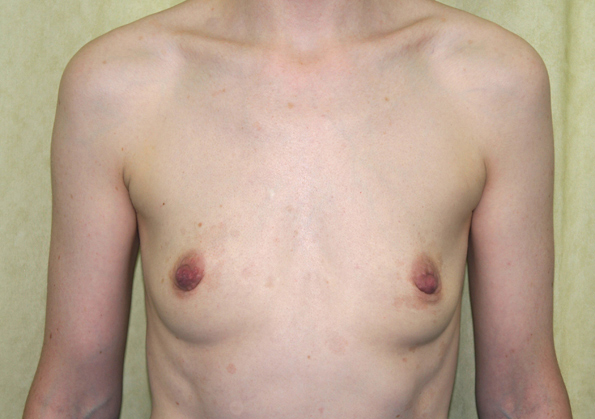 Breast Fat Transfer Before and After Picture