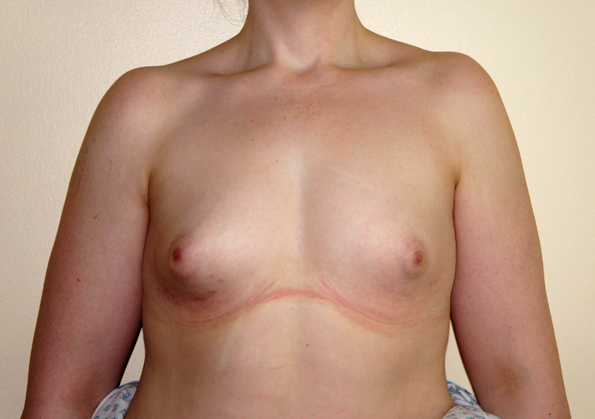 Breast Fat Transfer Before and After Picture