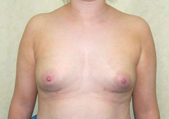 Breast Fat Transfer Before and After Picture